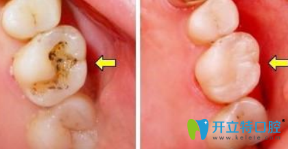 杭州口腔兒童齲齒治療效果案例