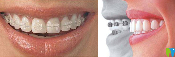 半隱形陶瓷托槽矯正和時(shí)代天使隱形矯正