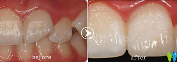 深圳愛康健齒科補牙治療前后對比圖