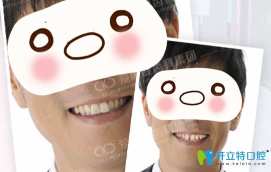 深圳愛康健口腔隱適美矯正效果案例來驗(yàn)證愛康健齒科好嗎