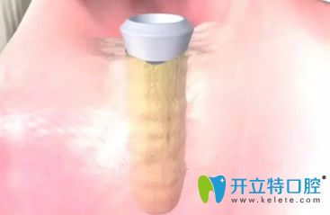 種植體與牙槽骨結(jié)合好后要安裝基臺(tái)
