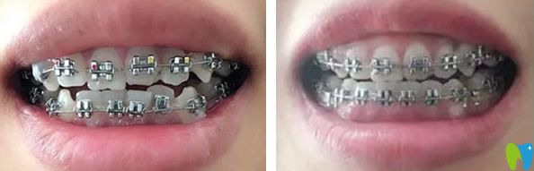 深圳瑞爾齒科牙齒矯正效果對比圖