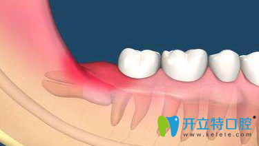 智齒牙齦腫痛怎么辦？分享牙齦快速消腫止痛小妙招