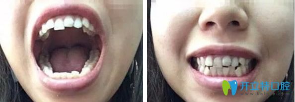 深圳瑞爾齒科牙齒矯正前