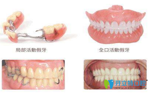 拔牙后鑲活動假牙的時間
