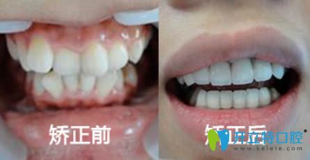隱適美隱形矯正前后對(duì)比效果