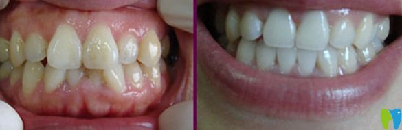 深圳歡樂口腔牙齒矯正效果對(duì)比圖