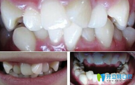 牙齒過度擁擠在深圳宏山齒科做矯正前圖片