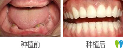 蒙恩齒科黃美華全口牙種植前后效果對(duì)比圖