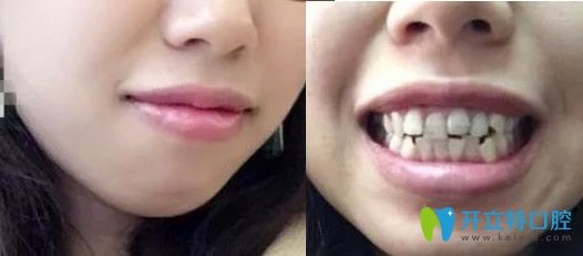 沒在深圳汪洋齒科口腔做牙齒矯正前照片