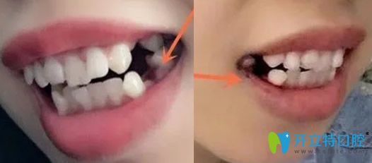 深圳汪洋齒科牙齒矯正拔4顆牙后的照片