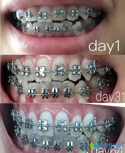 汪洋齒科牙齒矯正圖片對(duì)照?qǐng)D