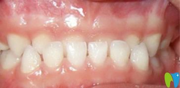 深圳歡樂口腔乳牙反頜矯正前 深圳歡樂口腔乳牙反頜矯正前