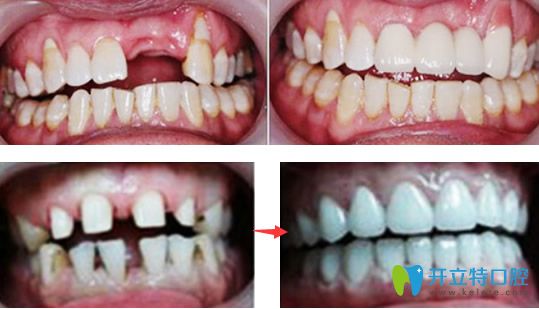 詹華院長種植牙+牙齒矯正修復效果案例 詹華院長種植牙+牙齒矯正修復效果案例