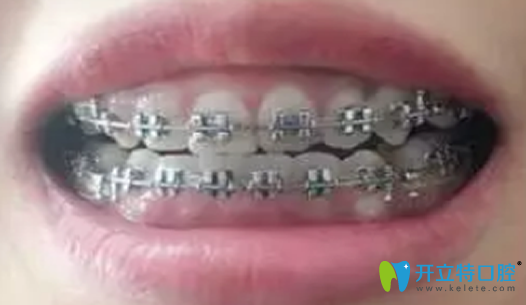 在深圳汪洋齒科做牙齒正畸第95天照片展示