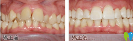 長(zhǎng)沙雅美口腔牙齒矯正前后效果對(duì)比圖