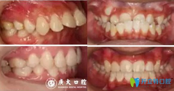 廣州廣大口腔牙齒矯正對(duì)比圖