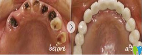 廣州雅皓口腔門診部牙殘根修復(fù)對(duì)比圖