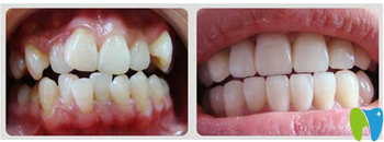 湛江致美口腔周秀紅牙齒矯正效果對(duì)比圖