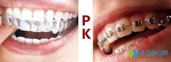 牙齒矯正中的牙箍和牙套有什么區(qū)別？通過比較來看哪個好