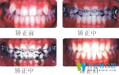 湛江南方口腔牙齒矯正前后效果對比圖