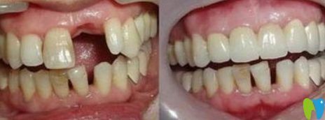 湛江南方口腔蔡蓮種植牙前后效果對比圖 湛江南方口腔蔡蓮種植牙前后效果對比圖