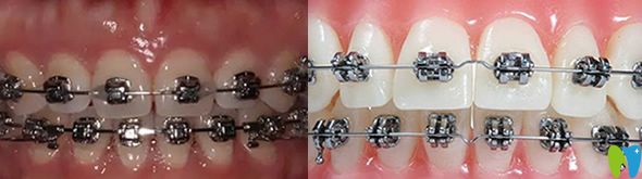 矯正牙齒自鎖托槽和傳統(tǒng)金屬托槽區(qū)別在哪?價格相差多少錢