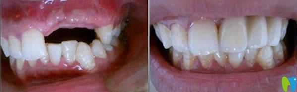 東莞固德德國微創(chuàng)種植牙前后對比案例