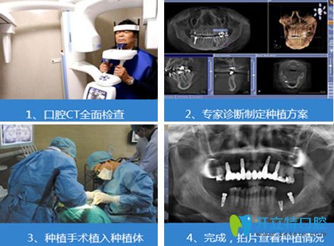 白振鑾主任微創(chuàng)無痛種植牙過程
