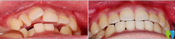 東莞固德口腔28歲牙齒矯正前后對比照