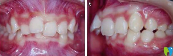 中山好民生口腔沒做牙齒矯正前的照片