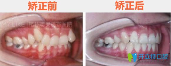 廣州美萊胡祥牙齒矯正前后對比效果 廣州美萊胡祥牙齒矯正前后對比效果