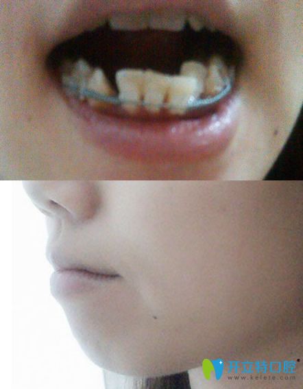 蘇州美奧口腔牙齒正畸過(guò)程中