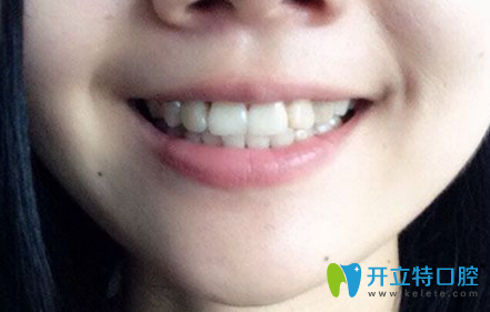 去蘇州美奧口腔做牙齒矯正一年多的照片