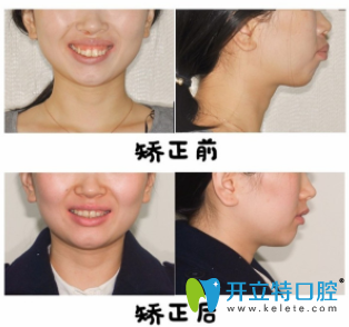 偉聯(lián)口腔黃淑微隱適美牙齒矯正前后效果對(duì)比圖