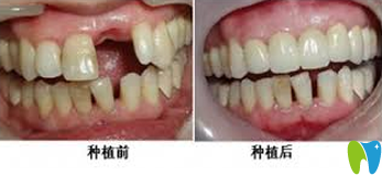 中大口腔種植牙前后效果對比圖