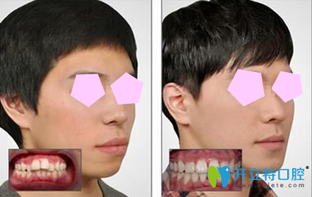 廣州偉聯(lián)口腔牙齒矯正效果對(duì)比圖