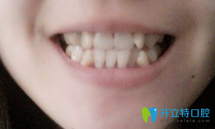 在蘇州美奧口腔做牙齒隱形矯正前正面