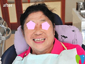 暨博口腔即可種植牙術(shù)后效果圖 暨博口腔即可種植牙術(shù)后效果圖