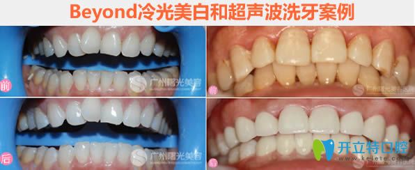 Beyond冷光美白和超聲波洗牙前后對比圖 Beyond冷光美白和超聲波洗牙前后對比圖