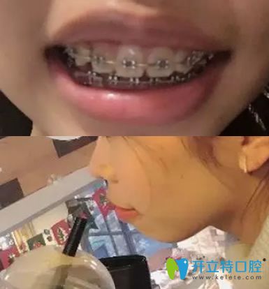 河山齒科牙齒矯正第217天照