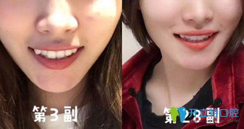 我在廣州德倫口腔做隱適美牙齒矯正過(guò)程中