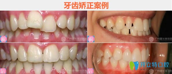 廣州曙光王浩主任隱形牙齒矯正前后對比效果 廣州曙光王浩主任隱形牙齒矯正前后對比效果