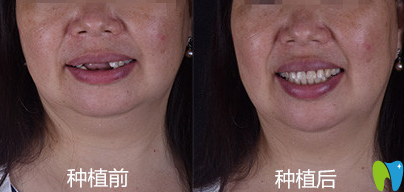 廣州好大夫口腔廖崇元種植牙前后效果對比圖 廣州好大夫口腔廖崇元種植牙前后效果對比圖