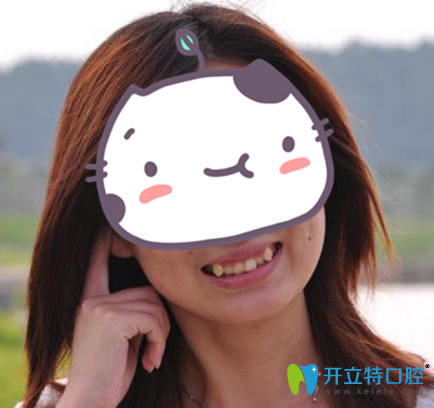 沒(méi)有武漢愛(ài)齒爾口腔正畸前樣子