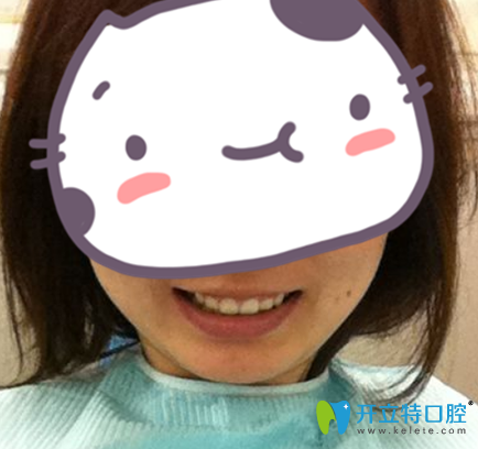 武漢愛(ài)齒爾口腔牙齒正畸15個(gè)月剛摘掉牙套照