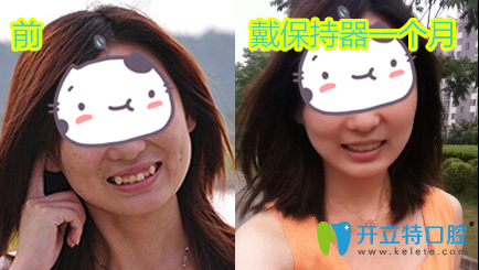 愛(ài)齒爾口腔牙齒矯正前后效果對(duì)比圖