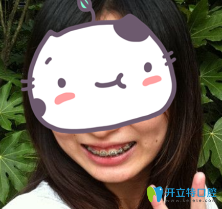 在武漢愛(ài)齒爾口腔做金屬托槽矯正4個(gè)月照片