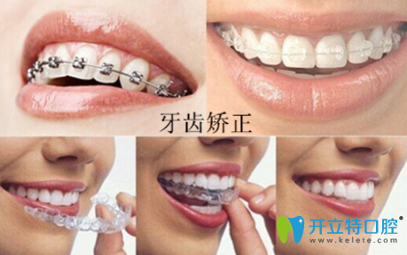 周佩佩科普：“牙齒矯正的年齡是什么時候？”