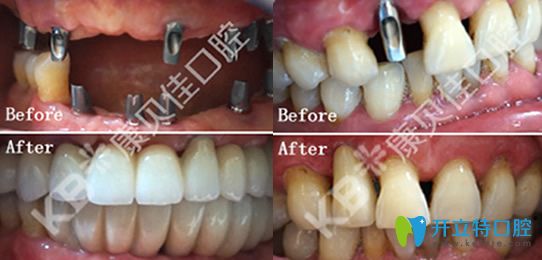 康貝佳院長李振芳多顆牙缺失CT親骨種植技術(shù)修復(fù)+單顆牙缺失即刻種植案例 康貝佳院長李振芳多顆牙缺失CT親骨種植技術(shù)修復(fù)+單顆牙缺失即刻種植案例